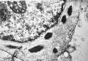 F,14y. | piloidal astrocytoma F,14y. | piloidal astrocytoma
